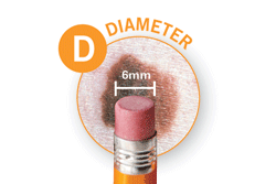 Public>Diseases>Skin-cancer>Types>Melanoma>Symptoms>Diameter