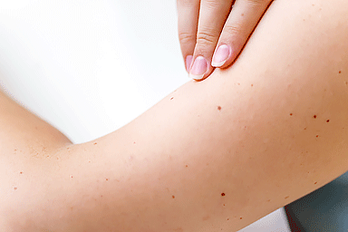 Woman checking her arm for signs of skin cancer