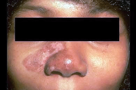 Discoid lupus treatment can prevent scars