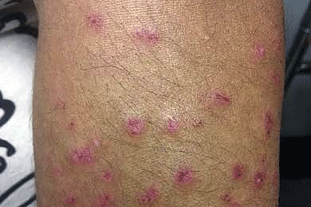 Drug-induced lupus on leg