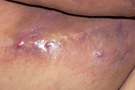 Hidradenitis suppurativa abscess