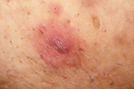 Hidradenitis suppurativa nodule