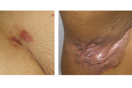 Early hidradenitis suppurativa and advanced hidradenitis suppurativa