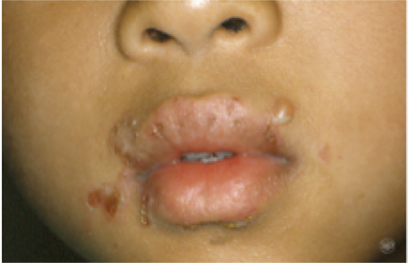 Impetigo blisters on a child's face