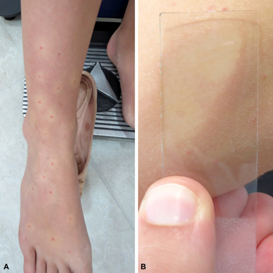 Image for DWII on eruptive pseudoangiomatosis