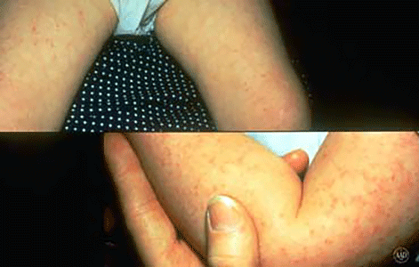 Child with keratosis pilaris