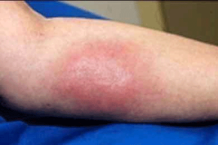 Lupus panniculitis rash on forearm