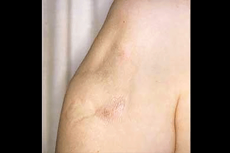 Lupus panniculitis scars on woman's arm