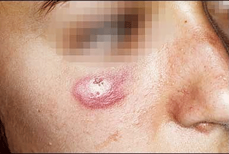 Lupus tumidus smooth patch on cheek