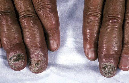 As sarcoidosis worsens, the nails can disappear and the fingertips swell