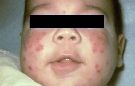 Neonatal rash on baby's cheeks