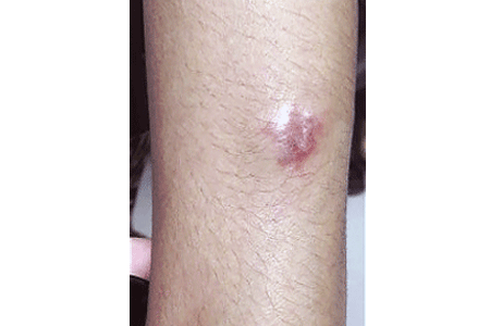 Plaque sarcoidosis on a woman's arm