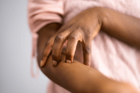 Woman showing dermatologist how lupus affects her skin