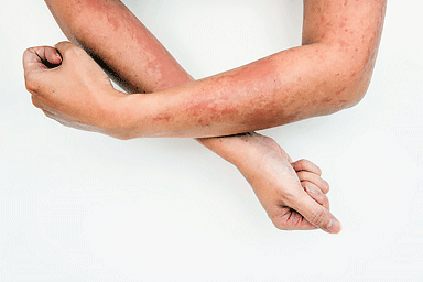 Image of a woman's arms with patches of dark skin