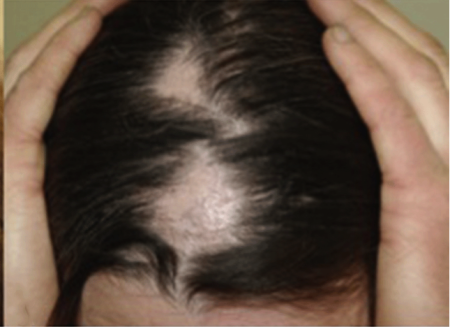 person showing bald patch on head