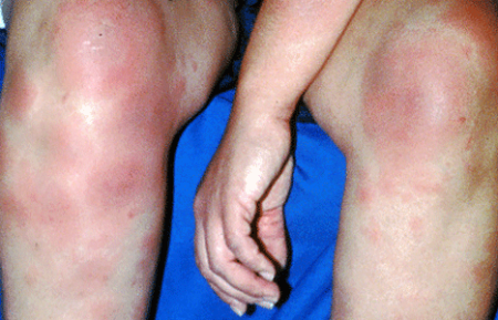 Sarcoidosis rash on both lower legs and the arm