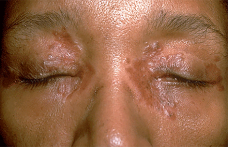 Woman with tiny, smooth bumbs of sarcoidosis on face