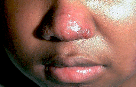 Sarcoidosis patches, deep lumps, and open sores on the face