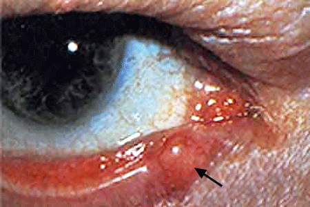 A growth on a man's lower eyelid is sebaceous carcinoma