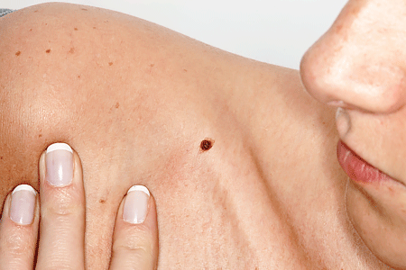 Woman looking at brown spot on shoulder