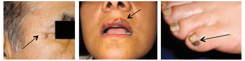 Skin cancer in Latinos