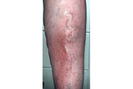 Early stasis dermatitis