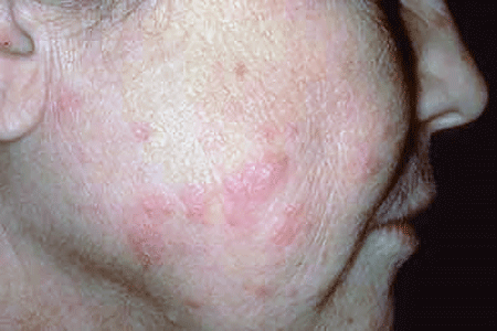 Subacute cutaneous lupus causes the skin to be sensitive to sunlight