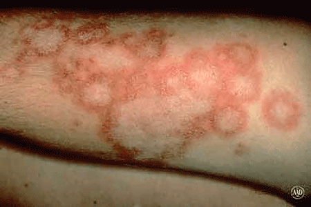 Subacute cutaneous lupus can cause a rash with a ring-like pattern