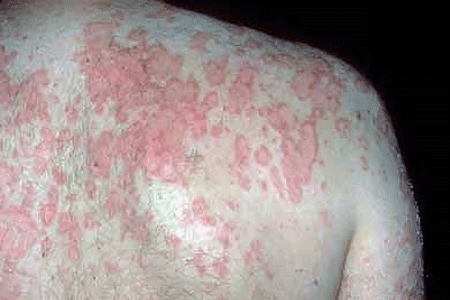 Subacute cutaneous lupus on the upper back